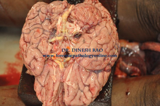 arterioraclerotic vessels